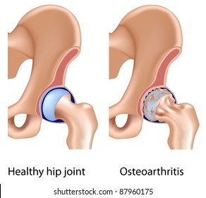 Osteoarthritis Of Hip Joint