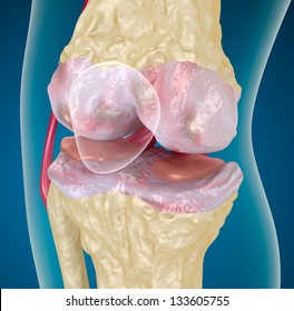 Osteoarthritis : Knee