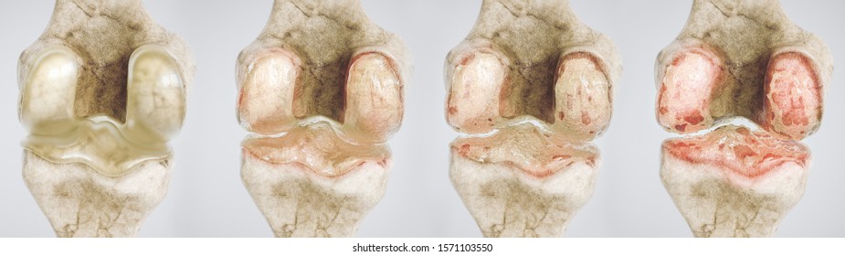 Osteoarthritis des Knies in vier Stufen - hoher Detailgrad - 3D-Rendering