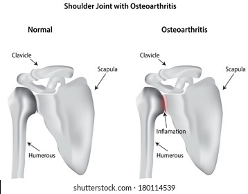 Osteoarthritis Of The Shoulder