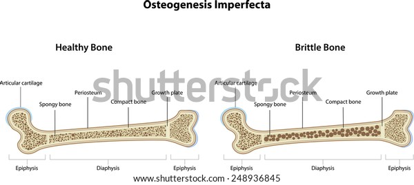 Osteogenesis Imperfecta Stock Illustration 248936845