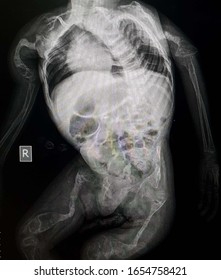 Osteogenesis Imperfecta Is Brittle Bone Disease. Whole Body X-ray Of This Case Shows Deformities Of Both Upper And Lower Limbs Long Bones , Pelvis, Spine And Rib Cage. 