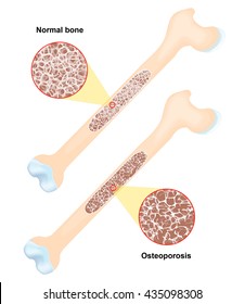 Osteoporosis Is A Disease Of Bones That Leads To An Increased Risk Of Fracture.