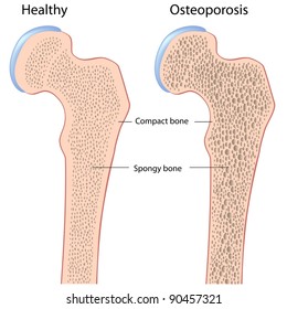 Osteoporosis Of Femur (hip Bone)