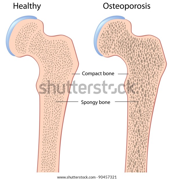 Osteoporosis Femur Hip Bone Stock Illustration 90457321