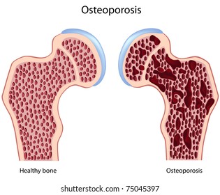 Osteoporosis Of Hip Bone