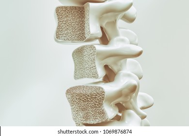 Osteoporosis On The Spine - 3d Rendering