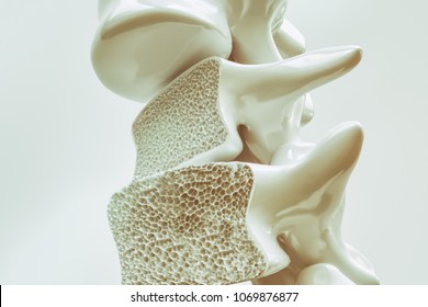 Osteoporosis On The Spine - 3d Rendering