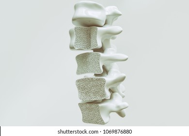 Osteoporosis On The Spine - 3d Rendering