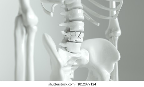 Osteoporose auf der Wirbelsäule - 3D-Darstellung
