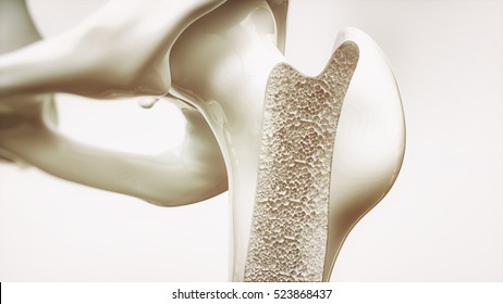 Osteoporosis Stage 2 Of 4 - Upper Limb Bones - 3d Rendering