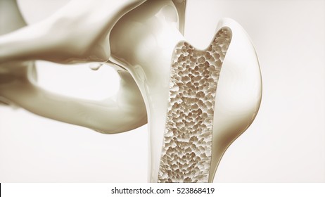 Osteoporosis Stage 4 Of 4 - Upper Limb Bones - 3d Rendering