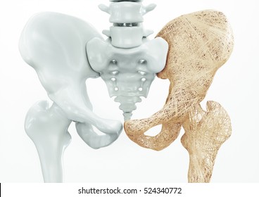 Osteoporosis Upper Limb Bones - 3d Rendering