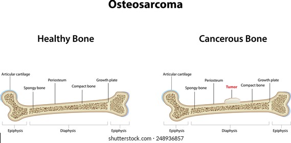 Osteosarcoma