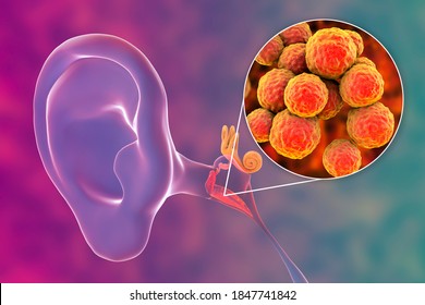 Otitis Media Caused By Bacteria Staphylococcus Aureus, An Inflammatory Disease Of The Middle Ear, 3D Illustration