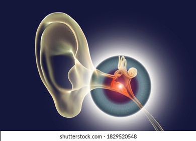 Otitis Media, A Group Of Inflammatory Diseases Of The Middle Ear, 3D Illustration