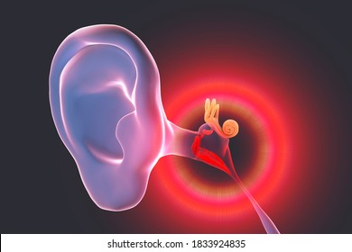 Otitis Media, A Group Of Inflammatory Diseases Of The Middle Ear, 3D Illustration