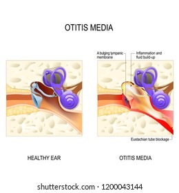 Otitis Media Is A Inflammatory Diseases Of The Middle Ear. Healthy Ear And  Middle Ear With Otitis. Illustration For Medical Use