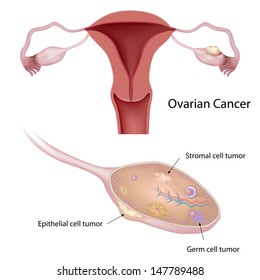 Ovarian Cancer