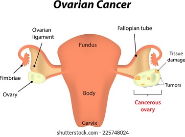 Ovarian Cancer