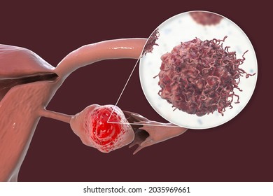 Ovarian Cancer, 3D Illustration Showing Malignant Tumor In The Left Ovary And Close-up View Of Cancer Cells