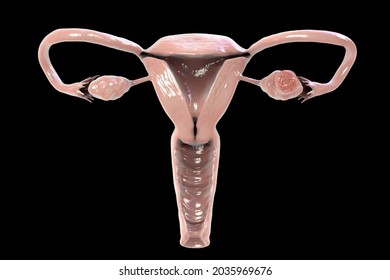 Ovarian Cancer, 3D Illustration Showing Malignant Tumor In The Left Ovary