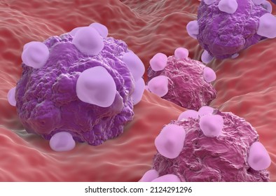 Ovarian Cancer Cell Variations - Closeup View 3d Illustration