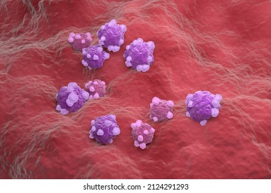 Ovarian Cancer Cell Variations - Isometric View 3d Illustration