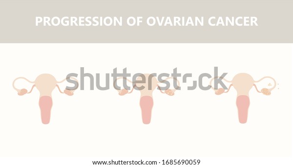 Ovarian Cancer Stages Female Ovary Cancer Stock Illustration 1685690059 ...
