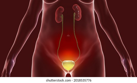 Overactive Urinary Bladder In A Female, 3D Illustration. A Condition Where There Is A Frequent Feeling Of Needing To Urinate, Sometimes With Loss Of Bladder Control Leading To Urge Incontinence