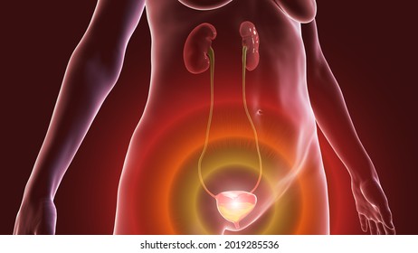 Overactive urinary bladder in a female, 3D illustration. A condition where there is a frequent feeling of needing to urinate, sometimes with loss of bladder control leading to urge incontinence