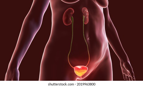 Overactive Urinary Bladder In A Female, 3D Illustration. A Condition Where There Is A Frequent Feeling Of Needing To Urinate, Sometimes With Loss Of Bladder Control Leading To Urge Incontinence