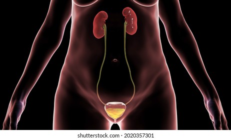 Overactive Urinary Bladder In A Female, 3D Illustration. A Condition Where There Is A Frequent Feeling Of Needing To Urinate, Sometimes With Loss Of Bladder Control Leading To Urge Incontinence