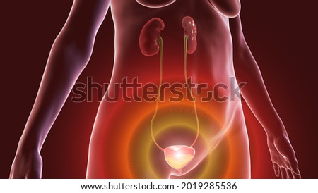 Overactive urinary bladder in a female, 3D illustration. A condition where there is a frequent feeling of needing to urinate, sometimes with loss of bladder control leading to urge incontinence