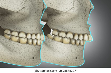 Overbite or a skeletal class II malocclusion, before and after illustration.Medically approved.