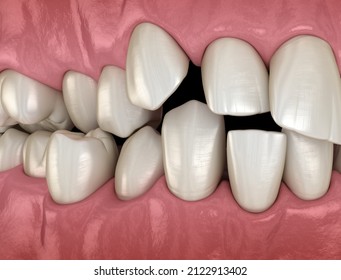 Overcrowded Teeth, Abnormal Dental Occlusion. Medically Accurate Tooth 3D Illustration