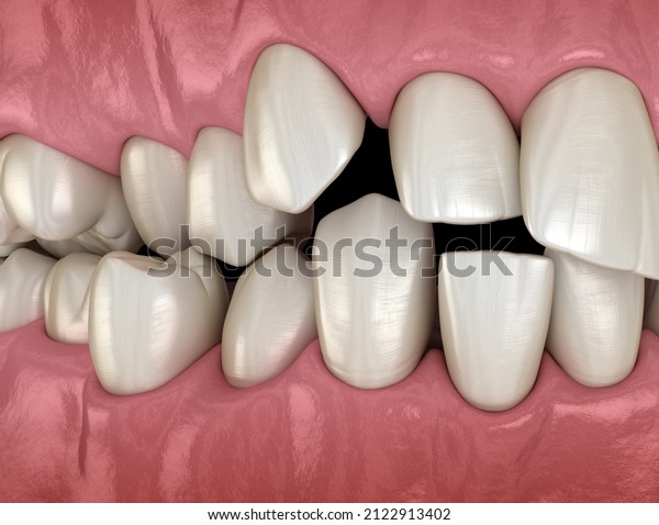 Overcrowded teeth, abnormal dental\
occlusion. Medically accurate tooth 3D\
illustration