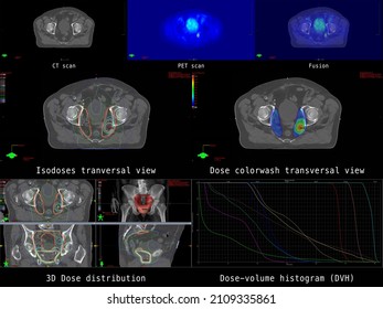 The Overview Shows CT And PET Cross-sections Of A Patient With A Malignant Neoplasm Of The Prostate And Pelvic Lymph Node Involvement. Furthermore, The Result Of The Calculation For Radiation Therapy.