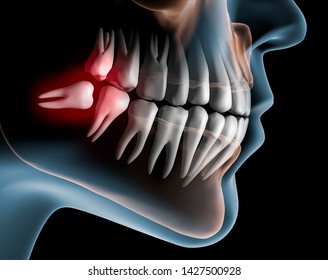 Pain Caused By Wisdom Teeth - 3D Illustration