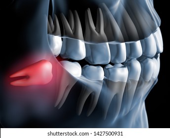 Pain Caused By Wisdom Teeth Closeup - 3D Illustration