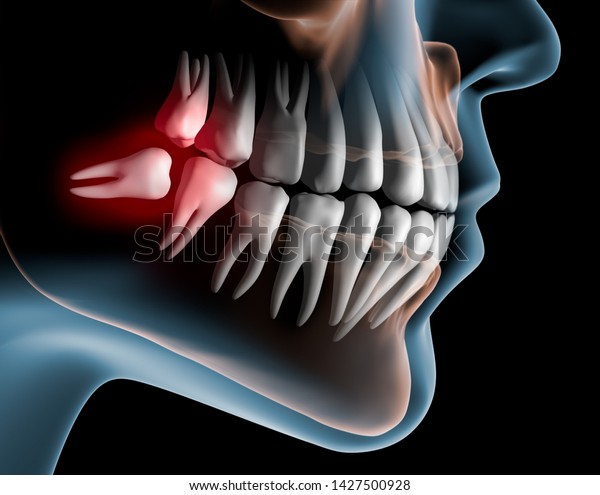 親知らずの歯による痛み 3dイラスト のイラスト素材