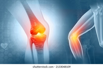 Pain In Knee Joint. Tendon Problems And Joint Inflammation On Dark Background. 3d Illustration