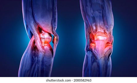 Painful Knee, Joint Pain, Arthritis, Osteoarthritis. Meniscus, Kneecap, Tendons, Bones, Ligaments Skeleton X-ray 3D Medical Anatomy Illustration. Workout Injury, Knee Replacement, Arthroplasty Concept