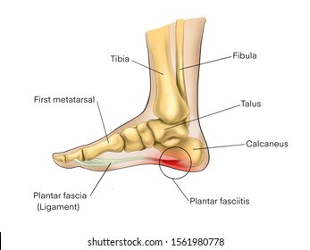 Painful Plantar fasciitis  ligament feet disorder . Study education medical scheme diagram high resolition picture for book orthopedic leg disease.  isolated on white background.Labeled.
