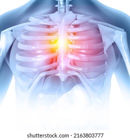 Painful Rib Anatomy, Fractured Ribs, Pain Highlighted In Glowing Red. 3d Illustration