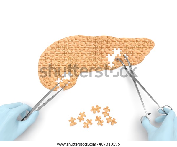 膵臓パズルのコンセプト 3dレンダリング 急性または慢性膵炎 膵糖尿病 膵がんの結果として膵臓手術を行う外科器具 道具 を持つ外科医の手 のイラスト素材