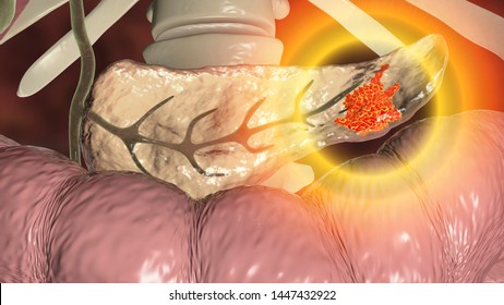 Pancreatic Cancer, Malignant Tumor Of Pancreas, 3D Illustration