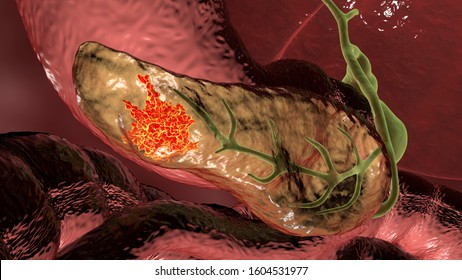 Pancreatic Cancer, Malignant Tumor Of Pancreas, 3D Illustration