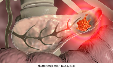 Pancreatic Cancer, Malignant Tumor Of Pancreas, 3D Illustration