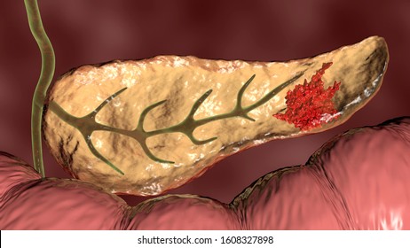 Pancreatic Cancer, Malignant Tumor Of Pancreas, 3D Illustration